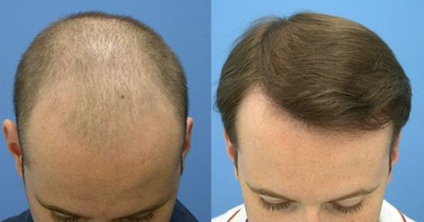 hair regrow ayurvedic treatment